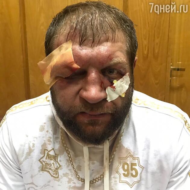 Так выглядел Емельяненко в прошлом году после боя с американцем. Так выглядел Емельяненко в прошлом году после боя с американцем.