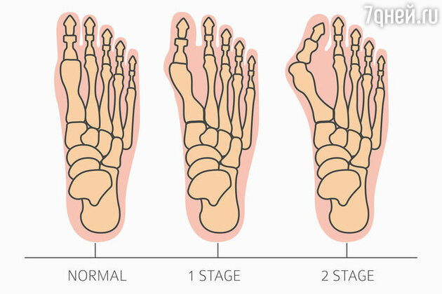 Hallux valgus Hallux valgus