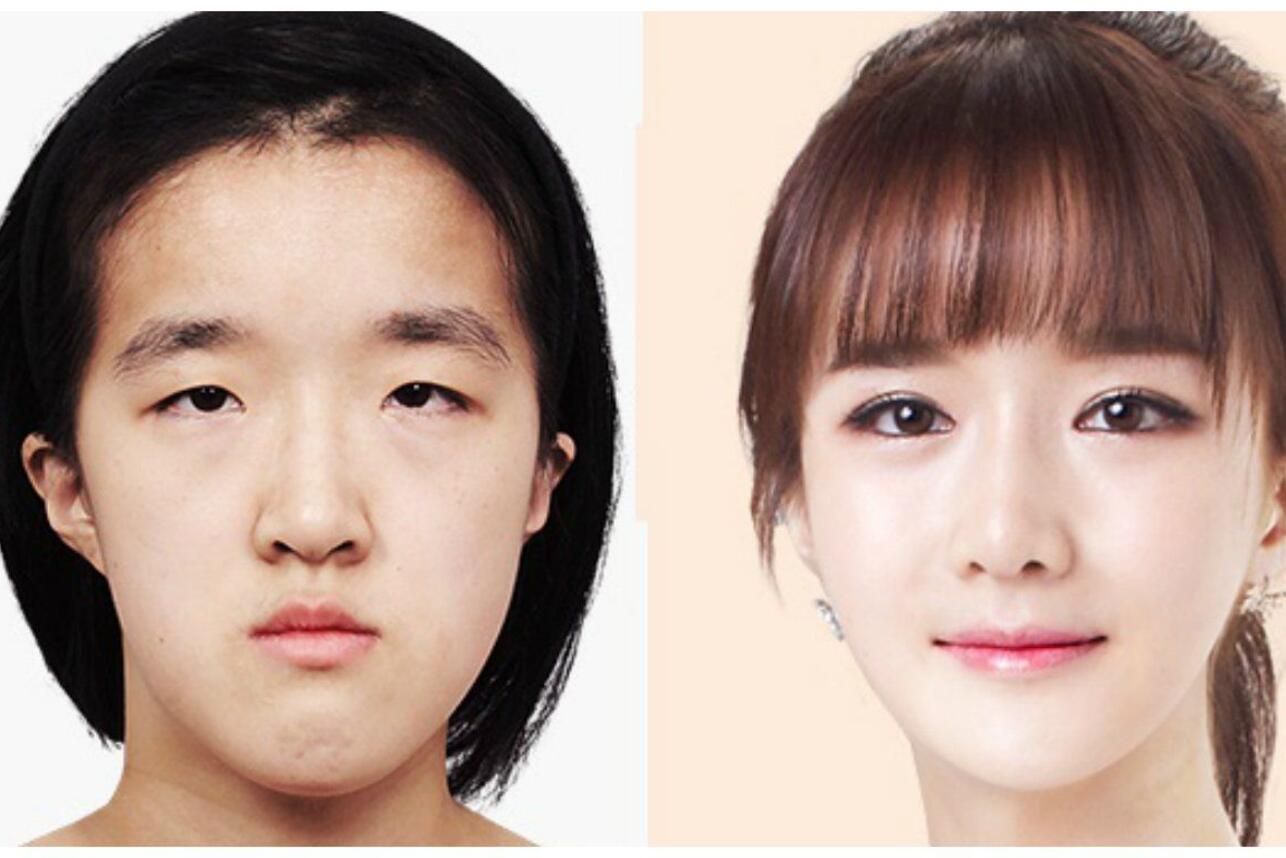 пластика разреза глаза фото до и после