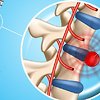 Межпозвоночная грыжа: нужно ли ее удалять? Межпозвоночная грыжа: нужно ли ее удалять?