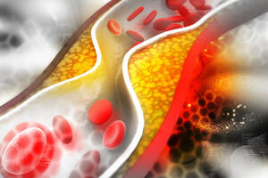 Атеросклероз: 5 главных заблуждений о холестерине и бляшках в сосудах