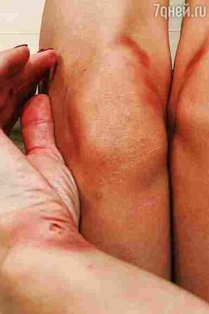 Синяки и ссадины Светланы Лободы