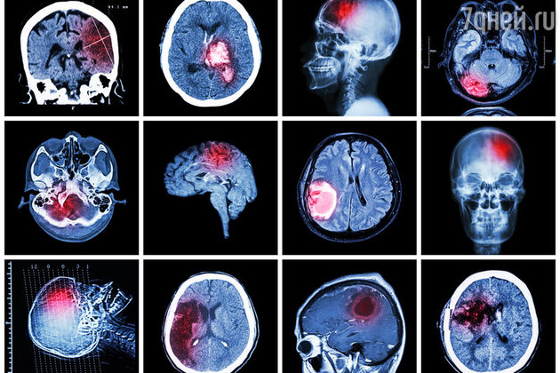 Как понять что у ребенка инсульт. Смотреть фото Как понять что у ребенка инсульт. Смотреть картинку Как понять что у ребенка инсульт. Картинка про Как понять что у ребенка инсульт. Фото Как понять что у ребенка инсульт