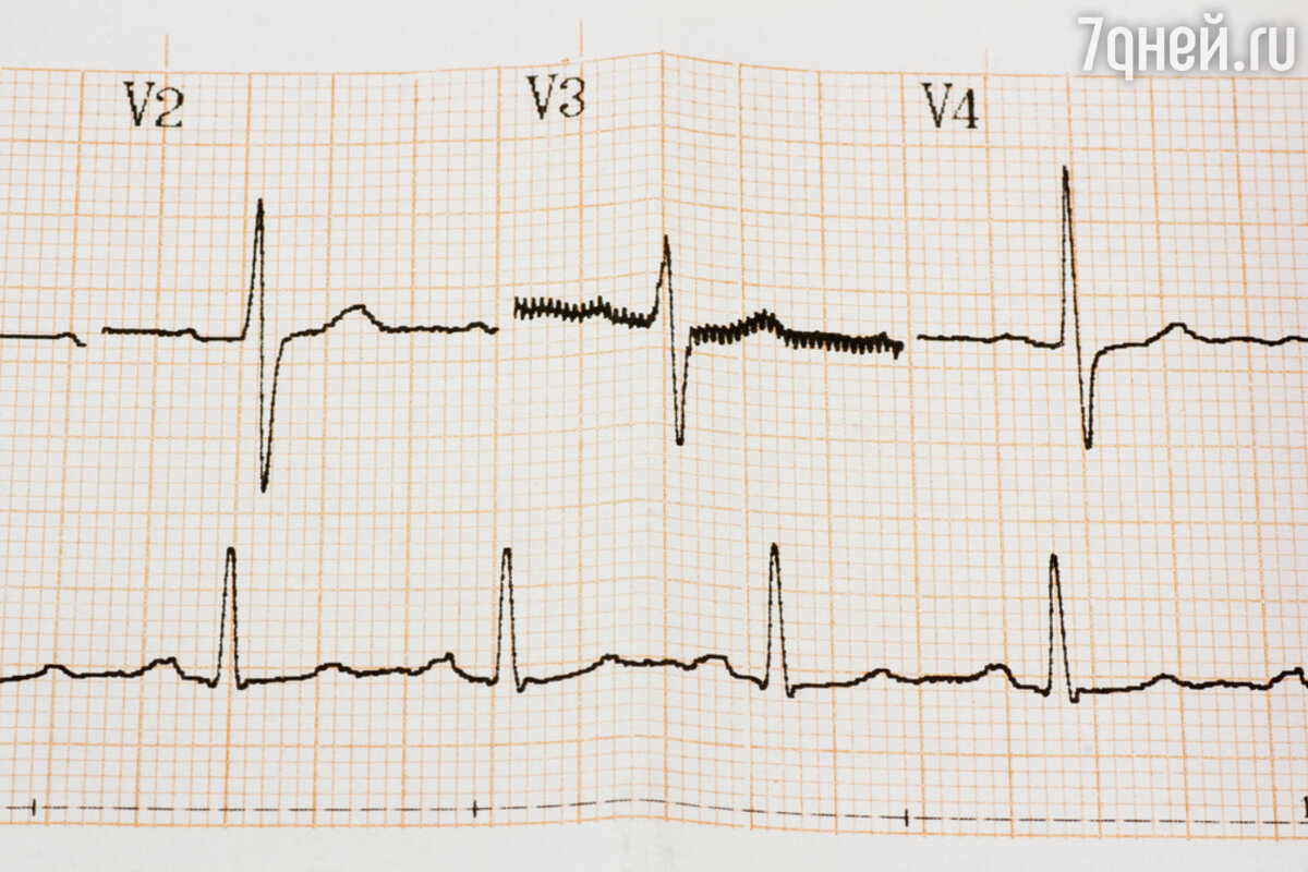 Аритмия: основные причины, как диагностируют и лечат болезнь? - 7Дней.ру