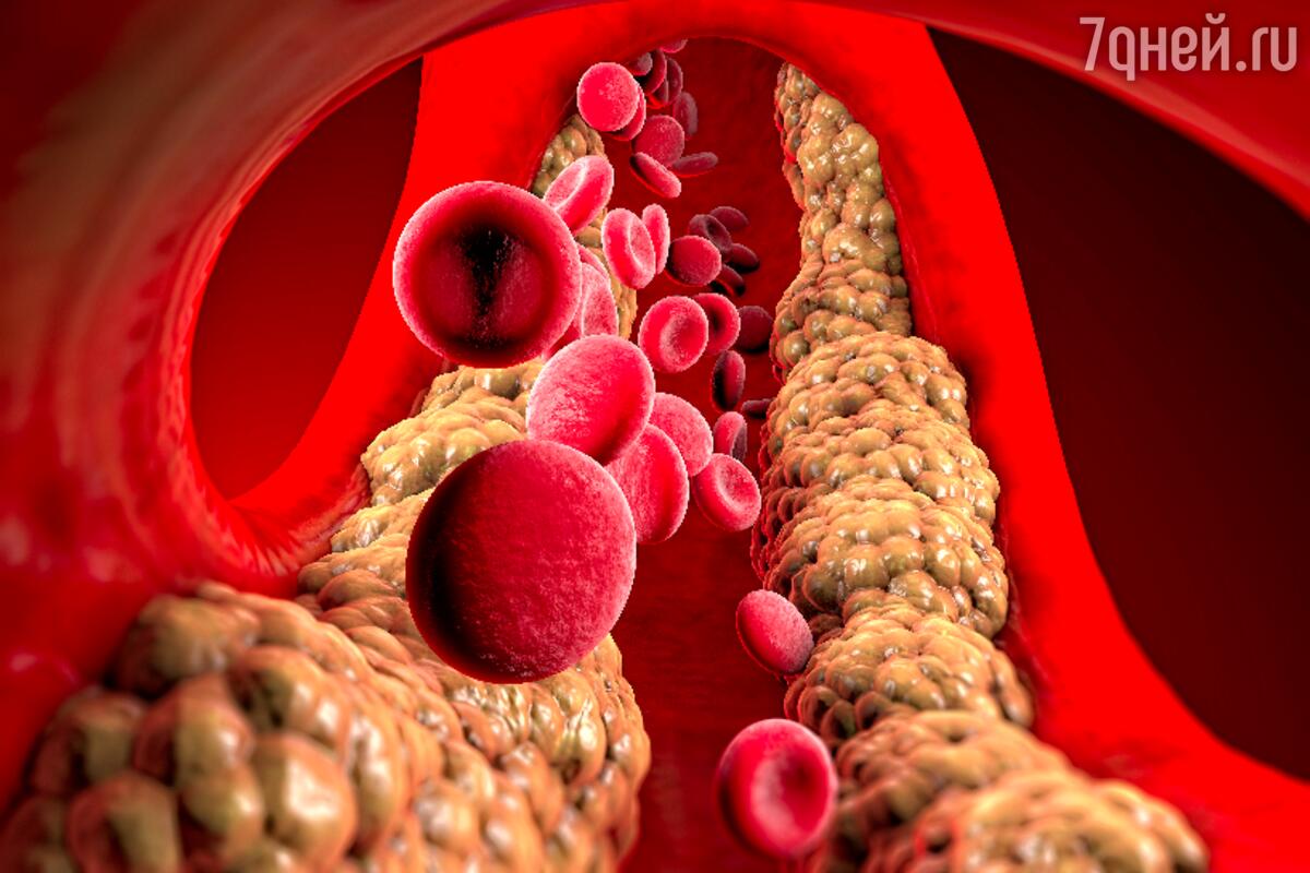 8 мифов о холестерине: развеем вместе с кардиологом - 7Дней.ру