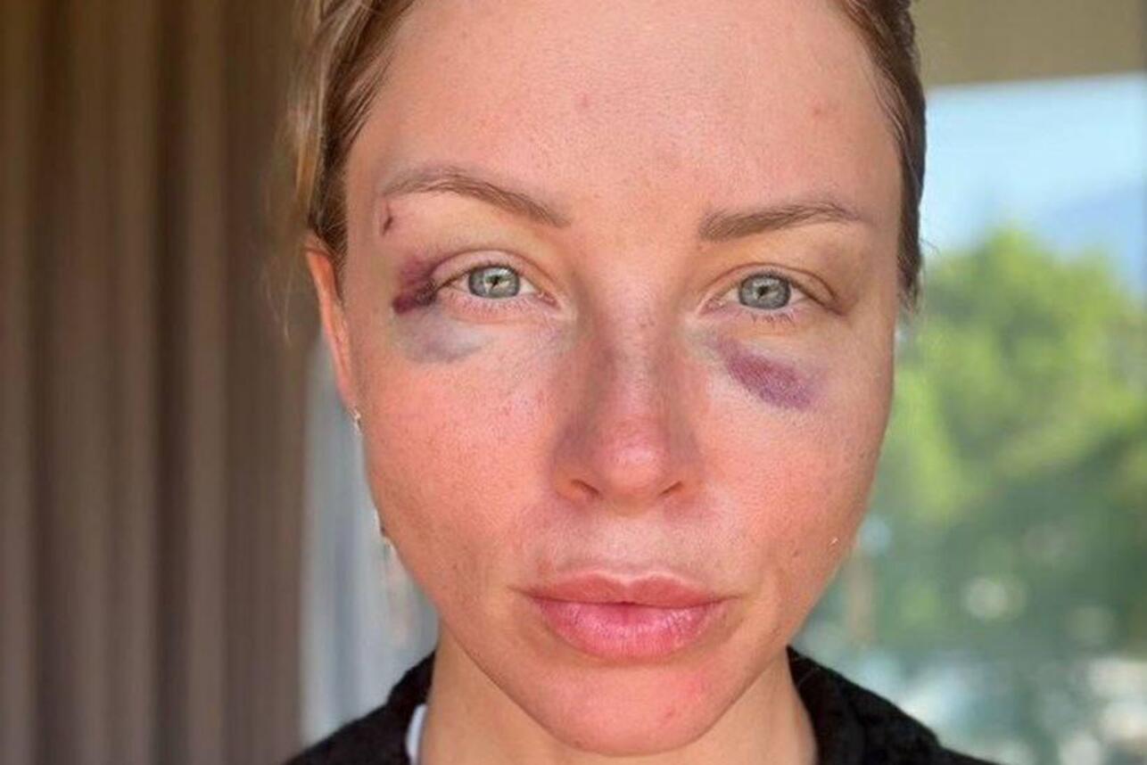 Полина Диброва в синяках