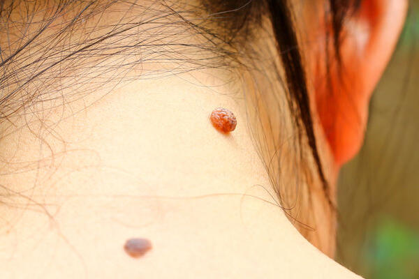 Меланома: что нужно срочно делать, если вы обнаружили подозрительную родинку?