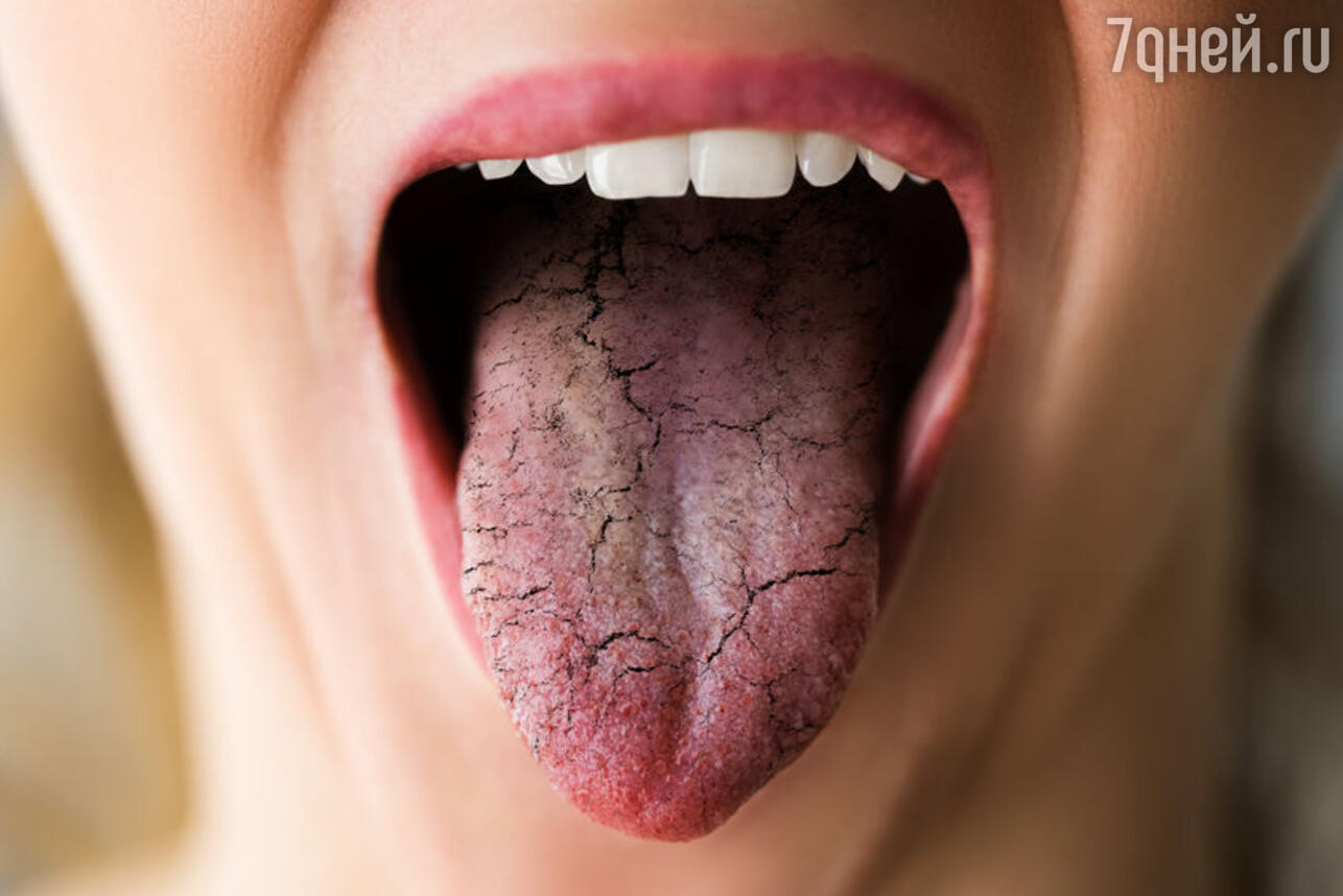 Симптомы, сопутствующие сухости во рту