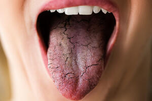 Сухость во рту и в носу: основные причины ксеростомии и корочек в ноздрях