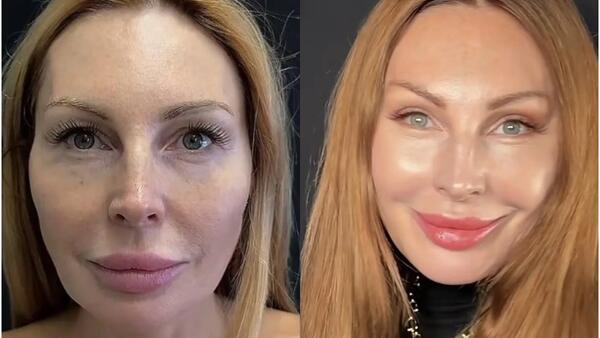 Звезды, не скрывающие пластику лица: как помолодели Бочкарева, Дубцова, Лолита, Боня и Борисова (фото до и после)