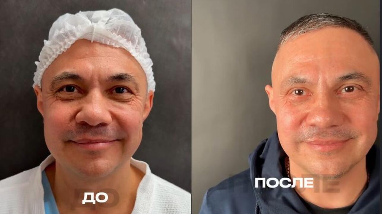 Плющенко задал тренд: Костя Цзю решился на пластическую операцию — фото