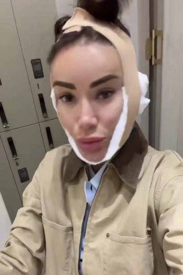 Айза показала честное фото после подтяжки лица в Корее: «Я чуть опухшая, но я в шоке»