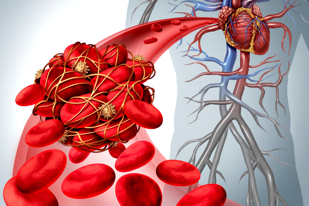 Тромбоз: вся правда об этой опасной проблеме - 7Дней.ру
