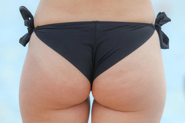 Пятое чувство: ягодицы могут предсказать развитие диабета второго типа