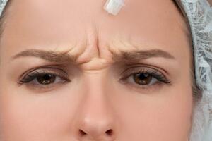 Косметолог объяснила, можно ли заболеть ботулизмом после уколов с ботоксом