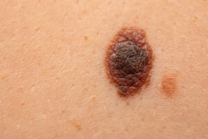 Меланома и загар: как обезопасить себя от самой опасной злокачественной опухоли кожи
