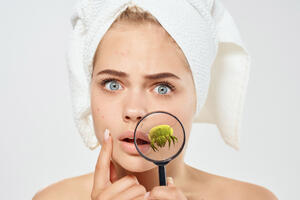 Демодекоз: виноват ли клещ в проблемах с акне