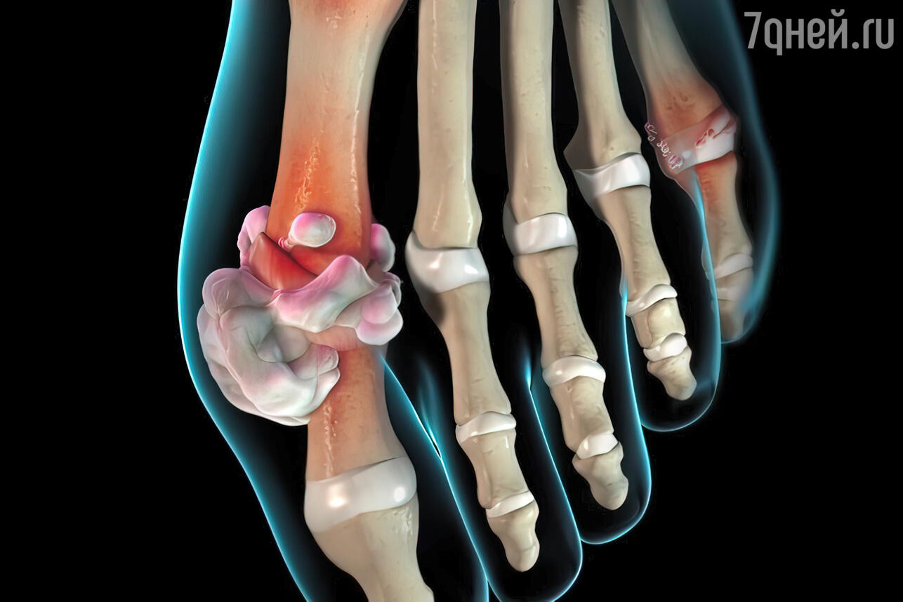 Какие бывают шишки на пальцах ног? | Травматолог-ортопед Петросян А.С.
