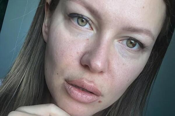 Рита Дакота показала ужасные последствия пластики лица — ямы, грыжи и складки