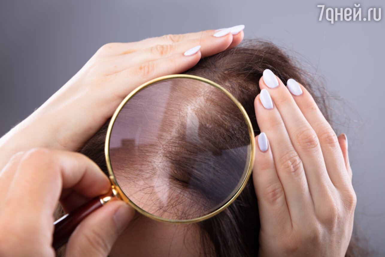 Причины выпадения волос у женщин фото