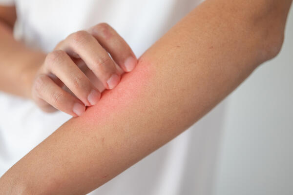 «Не чеши, а то хуже будет»: и эта правда. Но почему так хочется почесать зудящее место? Все не просто так — ученые