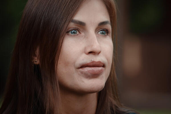 «Я не могла ни есть, ни пить»: как инъекции с вазелином едва не лишили женщин губ