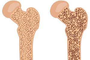 «Стеклянные кости»: что такое остеопороз и почему он возникает?