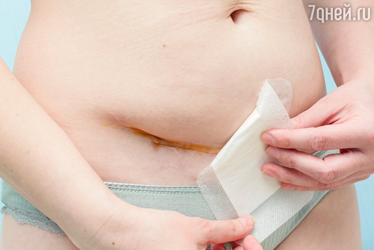 Как убрать кожу на животе после родов