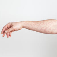 Кружева и узоры: такой рисунок на коже может быть признаком закупорки сосудов 