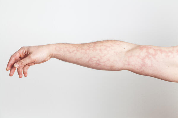 Кружева и узоры: такой рисунок на коже может быть признаком закупорки сосудов 