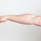 Кружева и узоры: такой рисунок на коже может быть признаком закупорки сосудов 