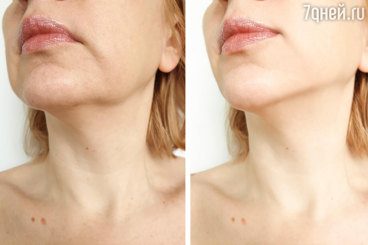 Как убрать брыли на лице и подтянуть обвисшие щеки: 7 эффективных способов