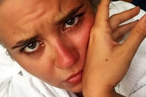 Дочь Валерии получила сильные ожоги на отдыхе в Дубае