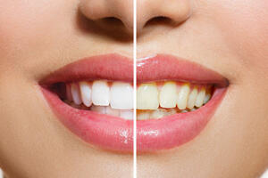 Домашнее и профессиональное отбеливание зубов: что выбрать?