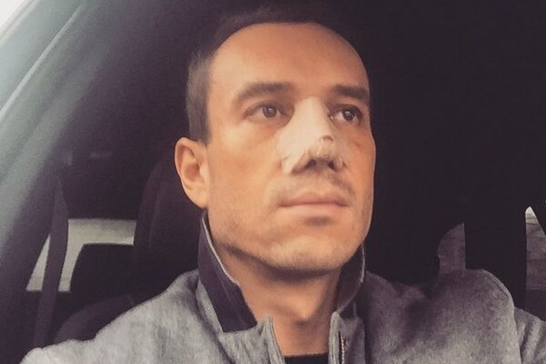 Михаил Терехин раскрыл подробности своей пластической операции