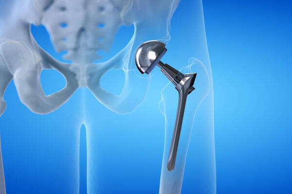 Эндопротезирование суставов: что важно знать перед операцией