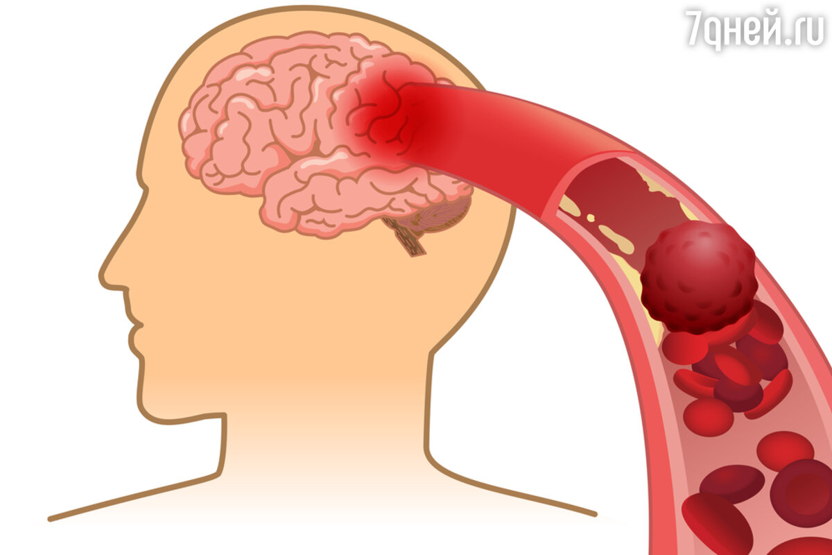 Инсульт: как предотвратить закупорку или разрыв мозгового сосуда - 7Дней.ру