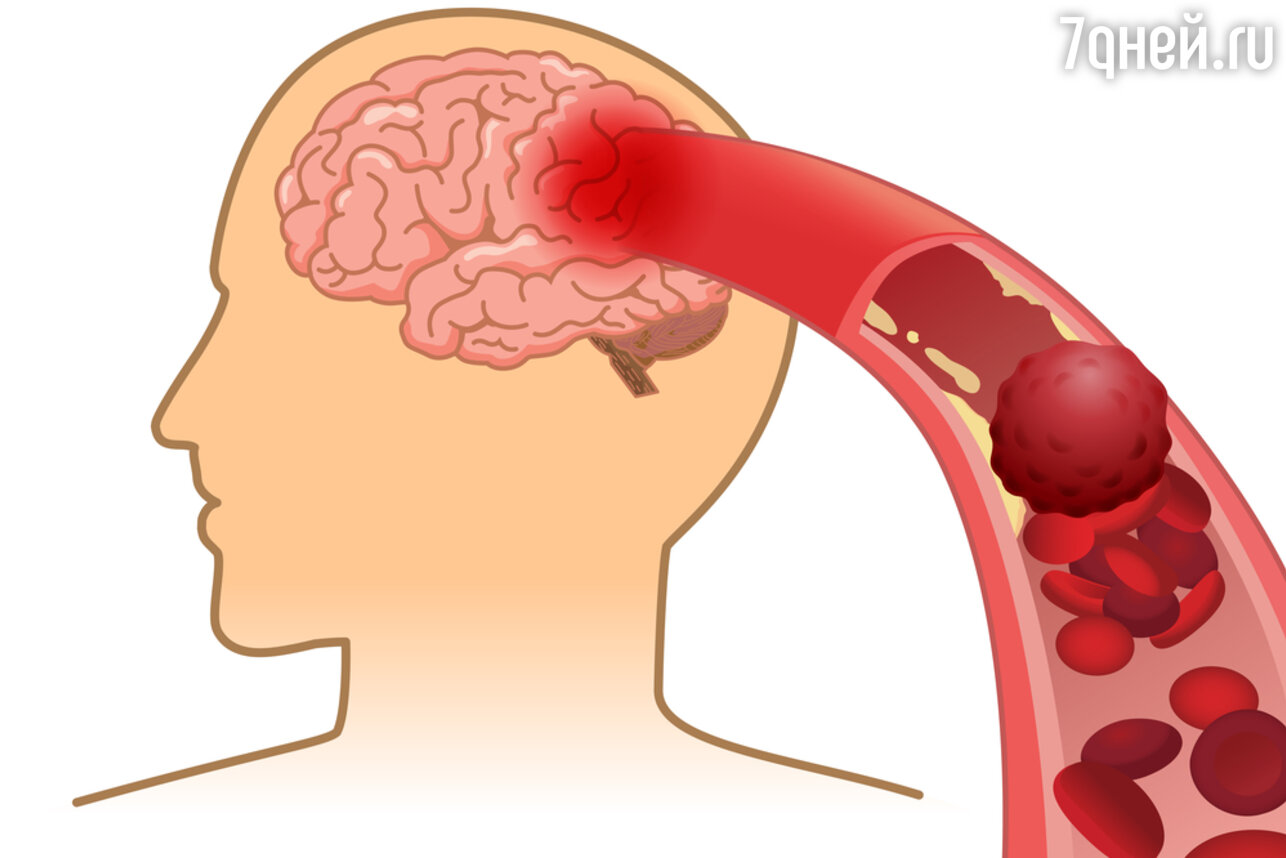 Ишемический инсульт — закупорка мозгового сосуда, она приводит к отмиранию участка мозга (некрозу), который кровоснабжался этим сосудом со всеми вытекающими из этого последствиями
