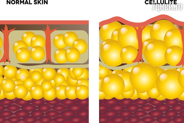 Слева схематически изображена кожа без целлюлита, а справа — кожа с проявлениями целлюлита
