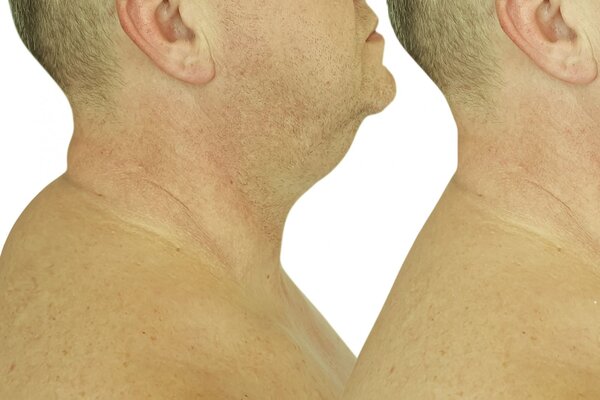 Холка: из-за чего возникает и как ее убрать в домашних условиях?