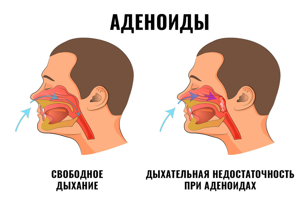 Аденоиды у детей: оперировать или лечить? - 7Дней.ру