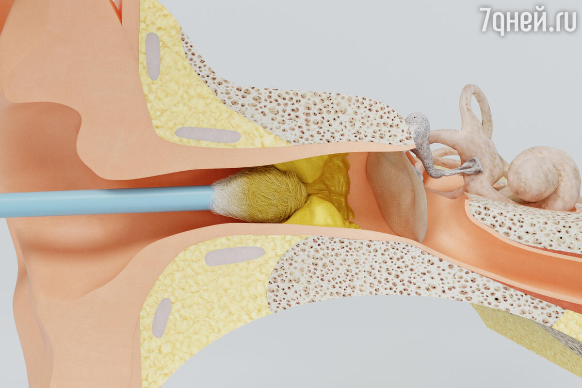 К чему снится ушная сера — сонник: ушная сера во сне | 7Дней.ру