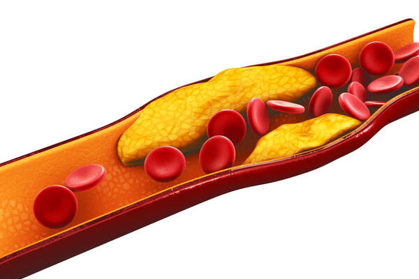 Закупорка и старение сосудов: какие привычки и продукты ускоряют эти процессы