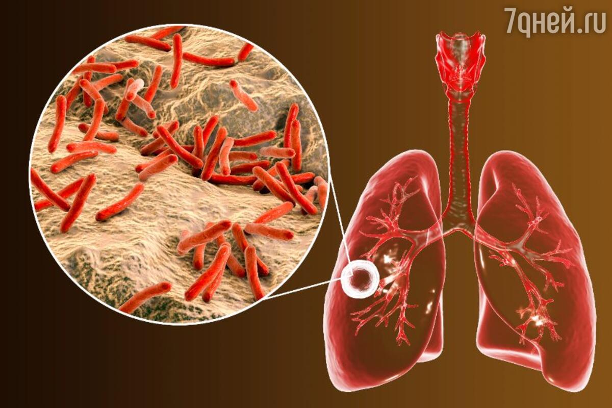 Холодный ночной пот и сильный кашель могут свидетельствовать о туберкулезе  - 7Дней.ру