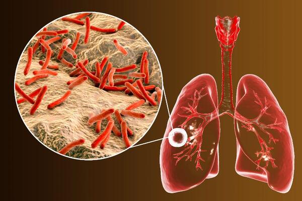Холодный ночной пот и сильный кашель могут свидетельствовать о туберкулезе