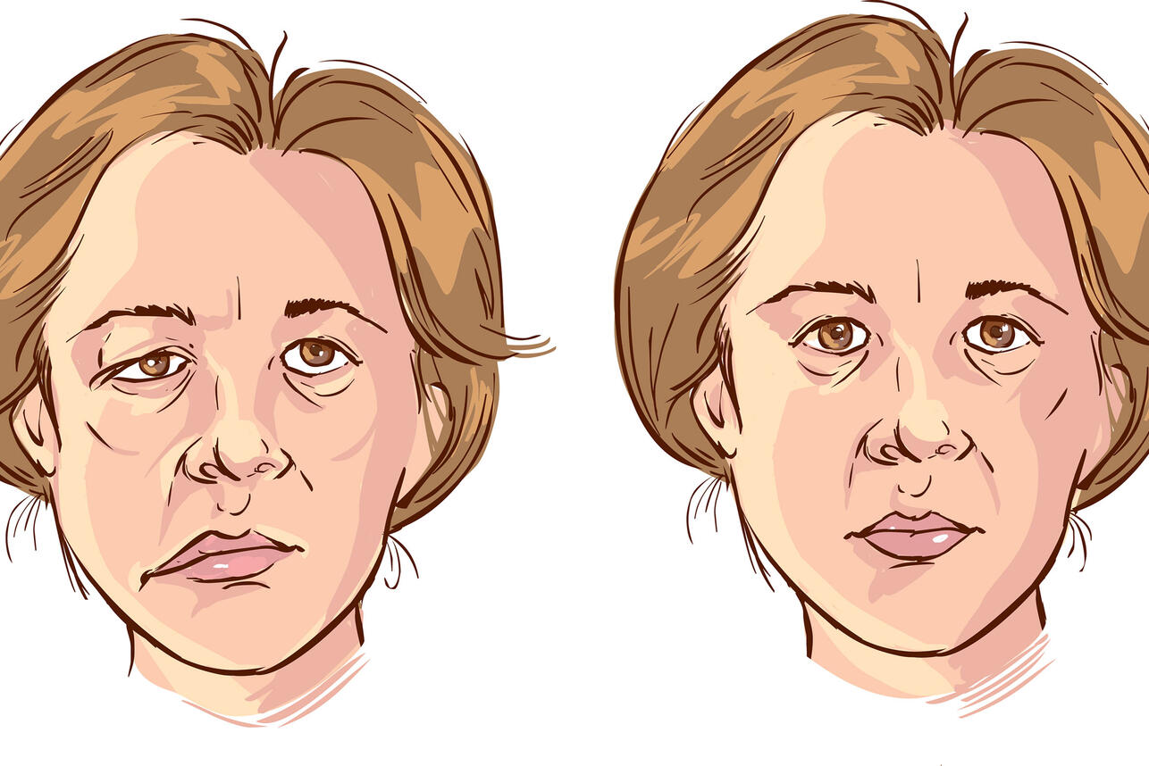 Паралич Белла: чем опасна эта патология лицевого нерва? - 7Дней.ру