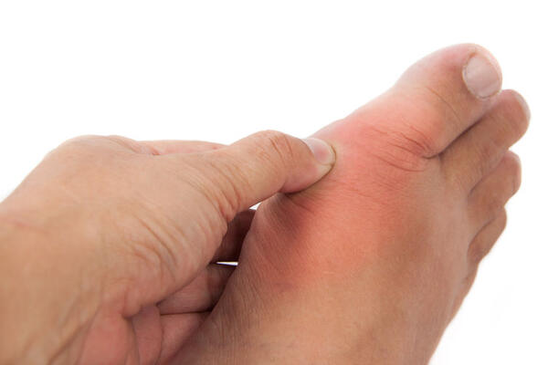 Как защититься от подагры?