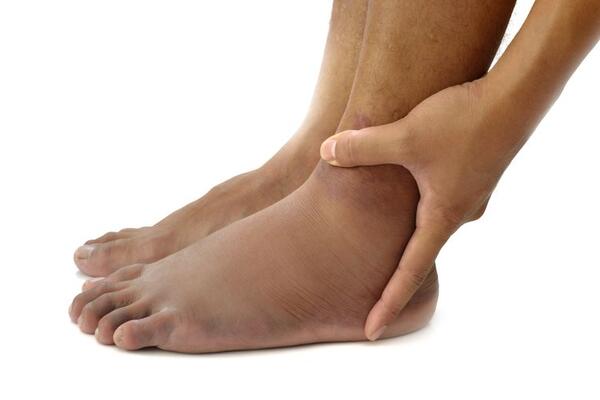 Отеки ног: причины возникновения и как их самостоятельно снять