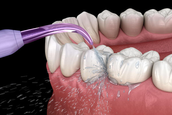 Ирригатор полости рта: для чего нужен и как его правильно выбрать