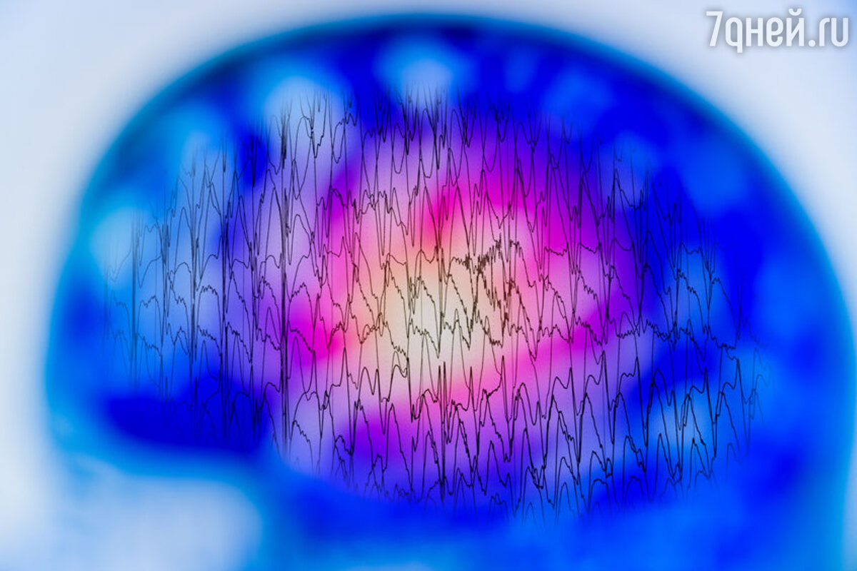 Эпилепсия: правда и мифы о болезни - 7Дней.ру